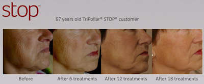 Tripollar Stop before and after photos on wrinkle